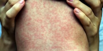 EUA bajo alerta: Sarampión se dispara y Chikungunya llega a NYC