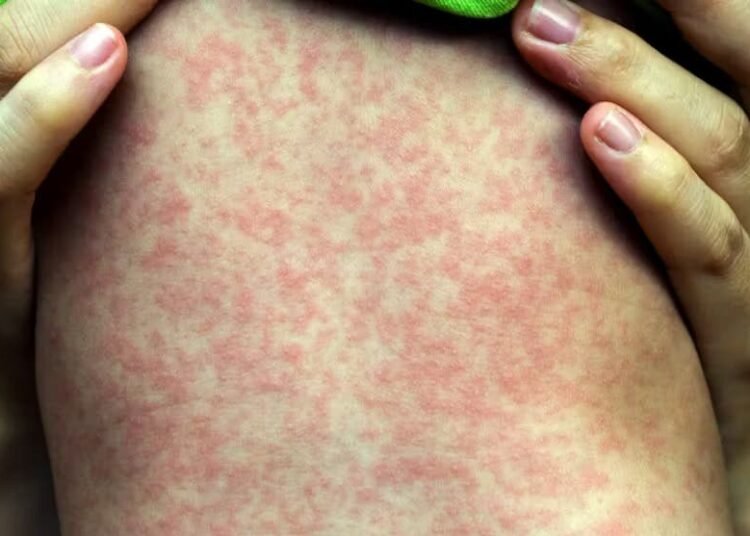 EUA bajo alerta: Sarampión se dispara y Chikungunya llega a NYC