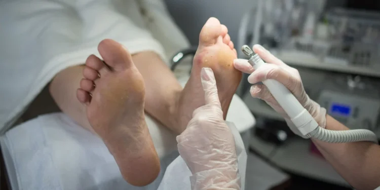 Tus pies te lo dicen: ¿Diabetes o mala circulación