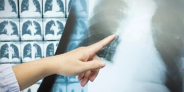 Adiós Cáncer de Pulmón: La Detección Temprana Es Tu Cura