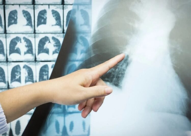 Adiós Cáncer de Pulmón: La Detección Temprana Es Tu Cura