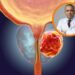 ¡Alerta Vital! Oncólogo Confirma: Detección Temprana Vence al Cáncer de Próstata y Salva Tu Vida