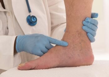 Diabetes: la alerta médica sobre la enfermedad arterial periférica que dispara el riesgo de amputación y muerte