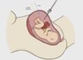 Hito médico en España: operan con éxito a un feto dentro del vientre materno para corregir una malformación intestinal