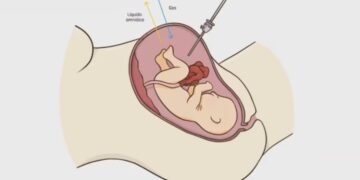 Hito médico en España: operan con éxito a un feto dentro del vientre materno para corregir una malformación intestinal