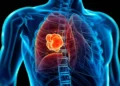 Revolución contra el cáncer de pulmón: el tratamiento sin quimioterapia que logra mejores resultados