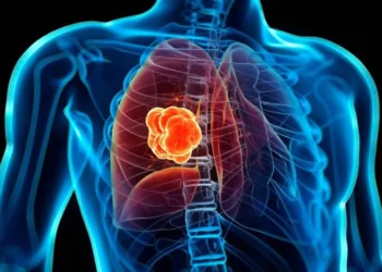 Revolución contra el cáncer de pulmón: el tratamiento sin quimioterapia que logra mejores resultados