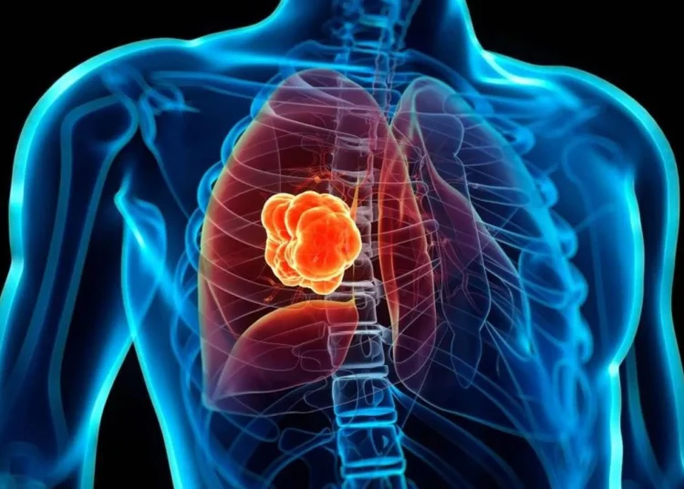 Revolución contra el cáncer de pulmón: el tratamiento sin quimioterapia que logra mejores resultados