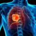Revolución contra el cáncer de pulmón: el tratamiento sin quimioterapia que logra mejores resultados